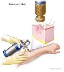 Cryosurgery